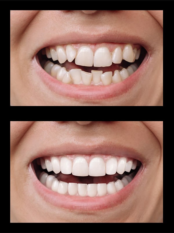 Dental Veneers Before & After Image