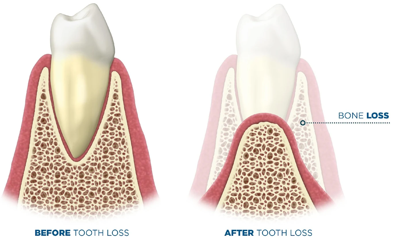 Cross-section diagram comparing a tooth in healthy bone with the collapsed ridge left after tooth loss