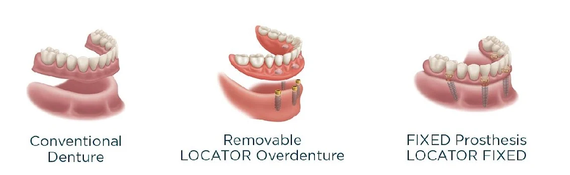 Tres modelos del maxilar inferior: una dentadura convencional, una sobredentadura LOCATOR removible y una prótesis LOCATOR fija