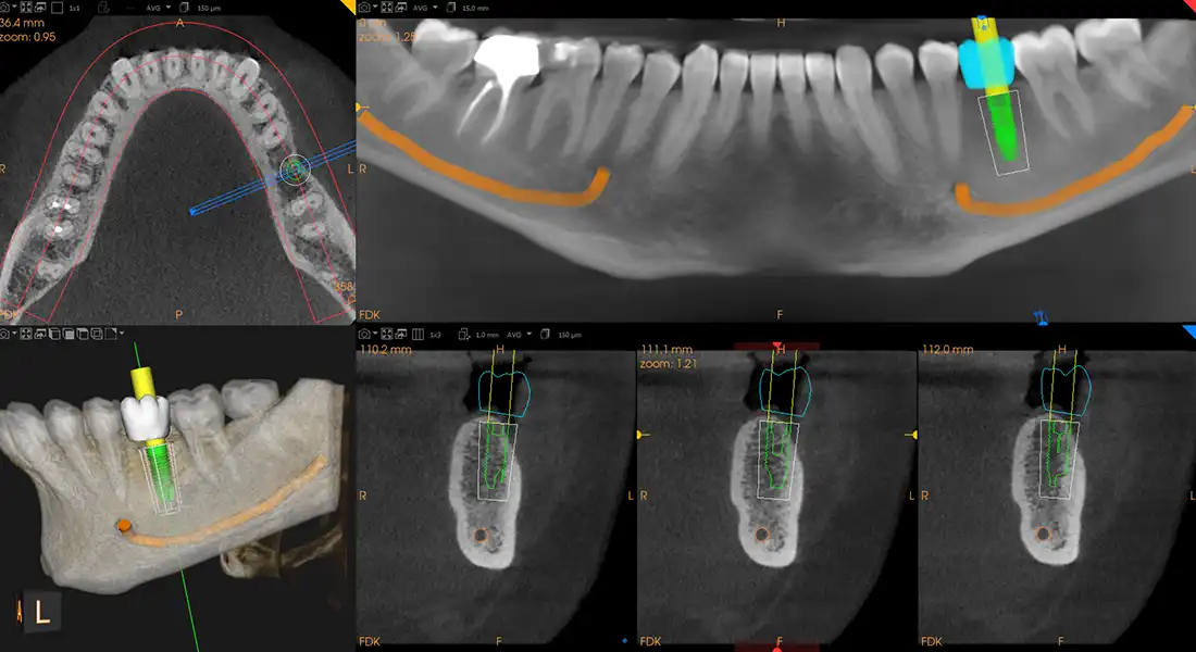 Software de planificación de implantes CBCT con cortes transversales, el conducto del nervio mapeado y la posición del implante simulada