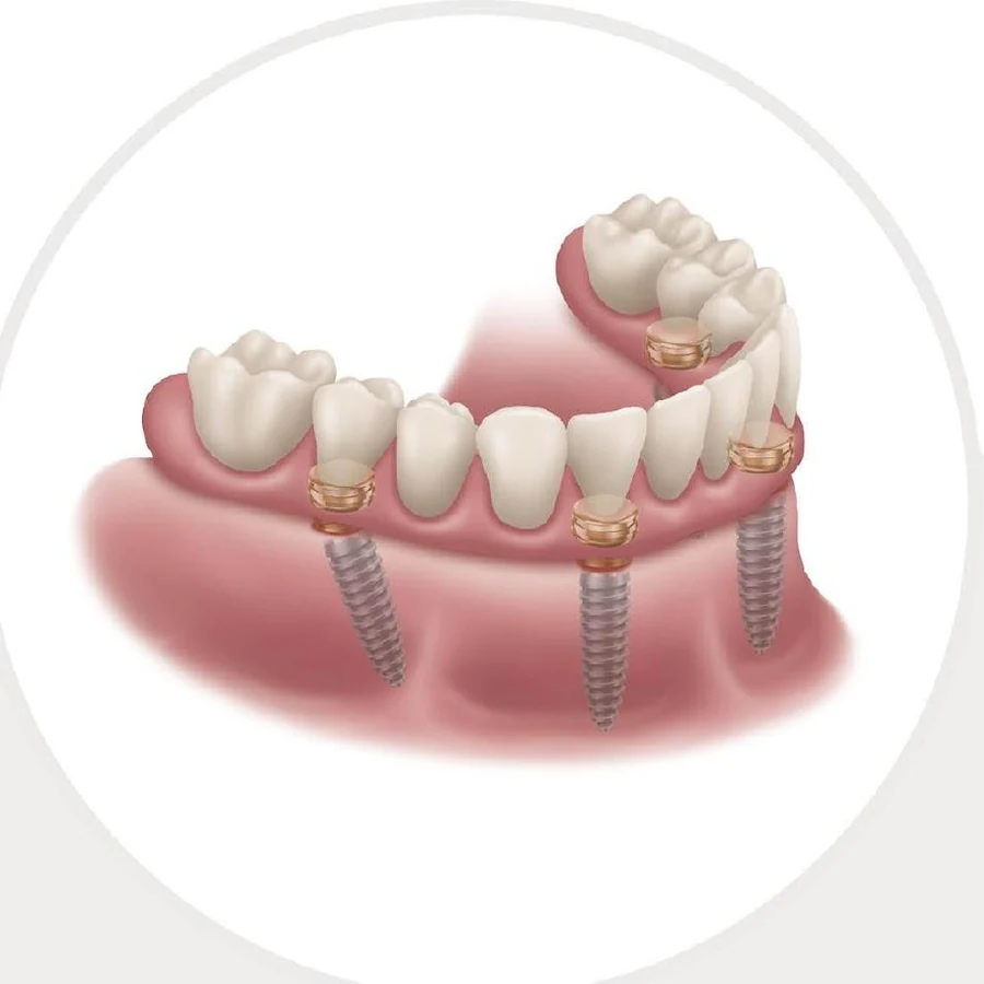Una prótesis fija soportada por cuatro implantes en el maxilar inferior