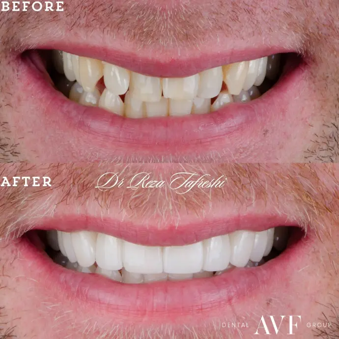 before and after dental