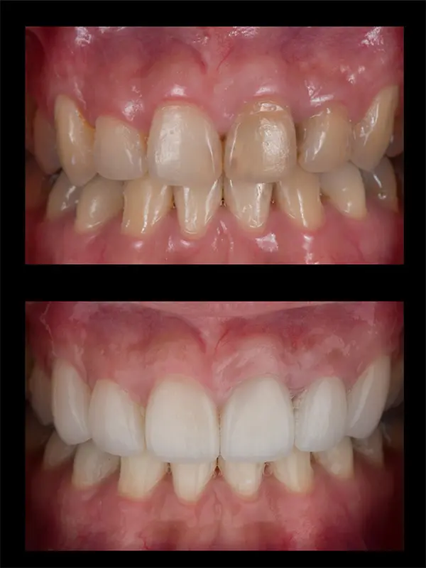 Teeth Whitening Rsult