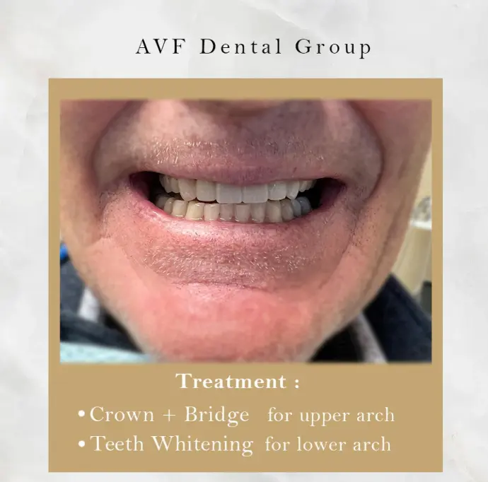 Dental crown bridge patient