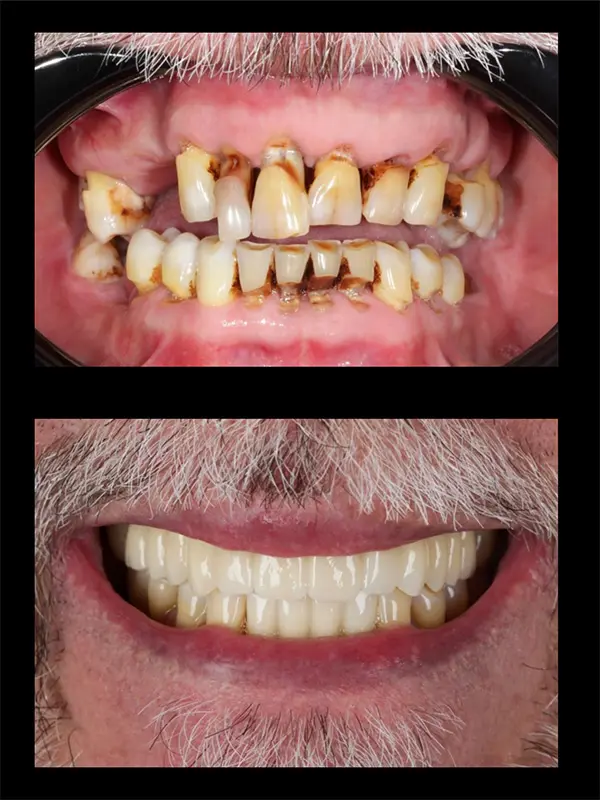 "Smile makeover transformation showing improved alignment and color"