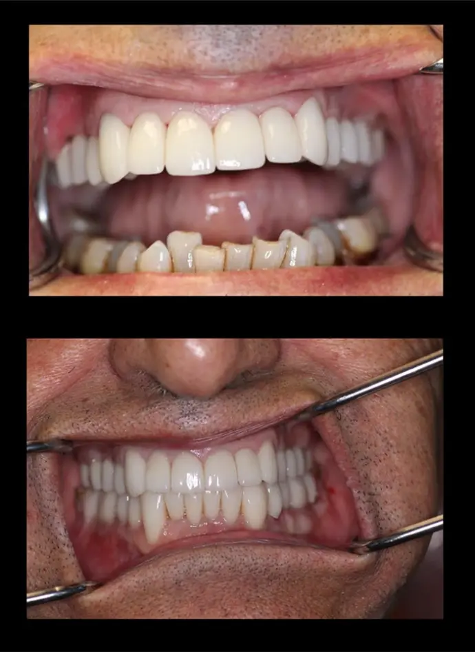 Full Mouth Reconstruction Before and After