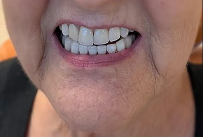 Full mouth reconstruction Result