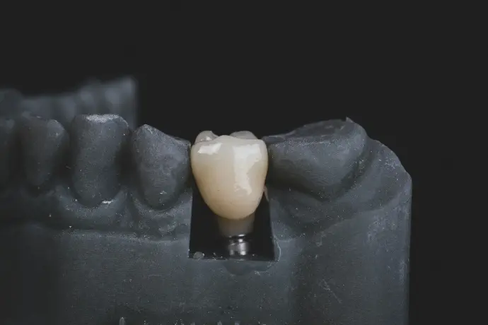 single dental implant