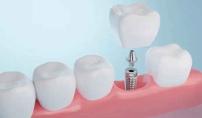 Single tooth implant illustration