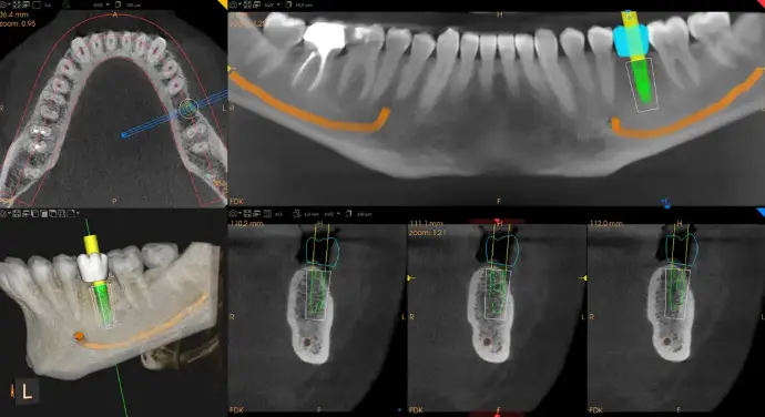 Dental X-ray showing a successfully placed single implant