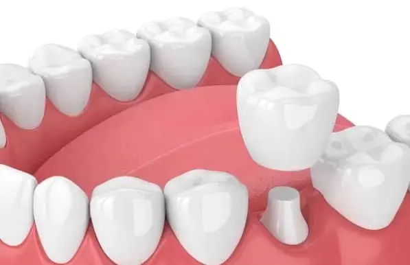 Why are Dental Crowns needed