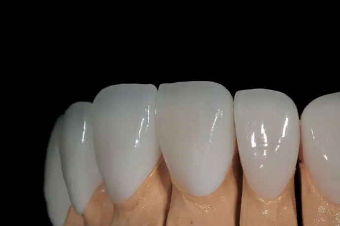 Denture in Orange County sample