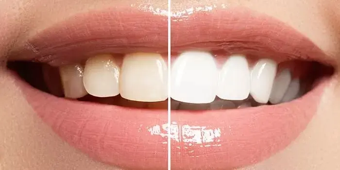 What can I expect after Professional Teeth Whitening