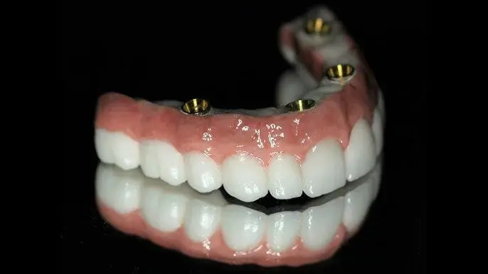 Implant Denture Image