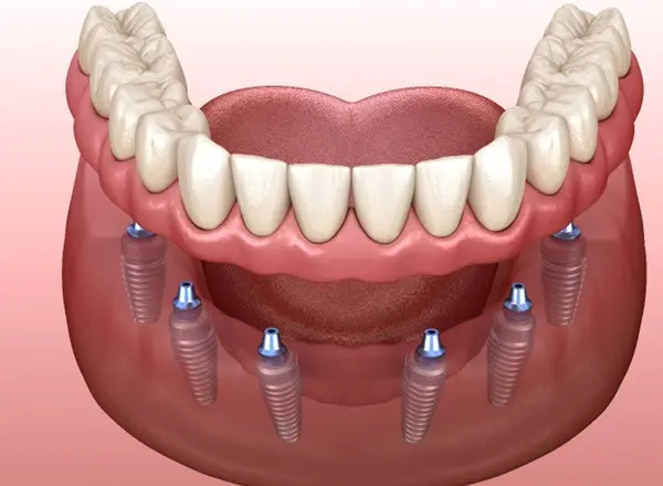 Implant Denture