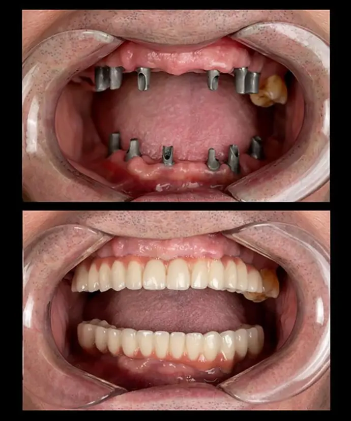 Dental Implant Before and After