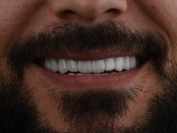 Dental Vener Emax at AVF Dental