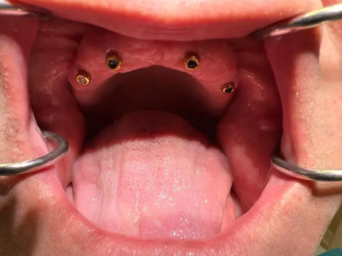 Implant Denture Prepration in Aliso Viejo