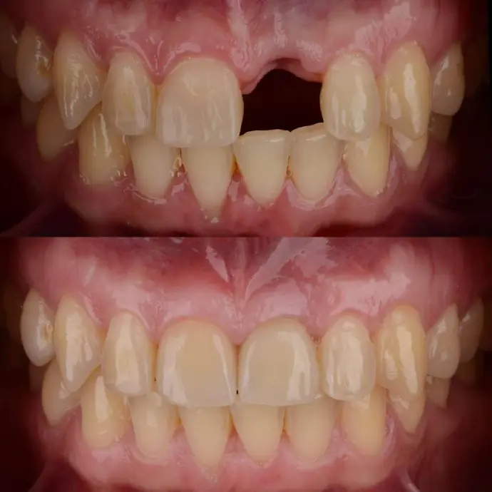 Single Tooth Implant before &amp; After