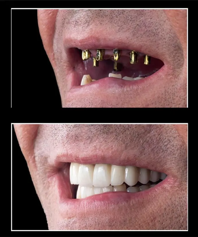 Multiple Implant Before &amp; After picture male