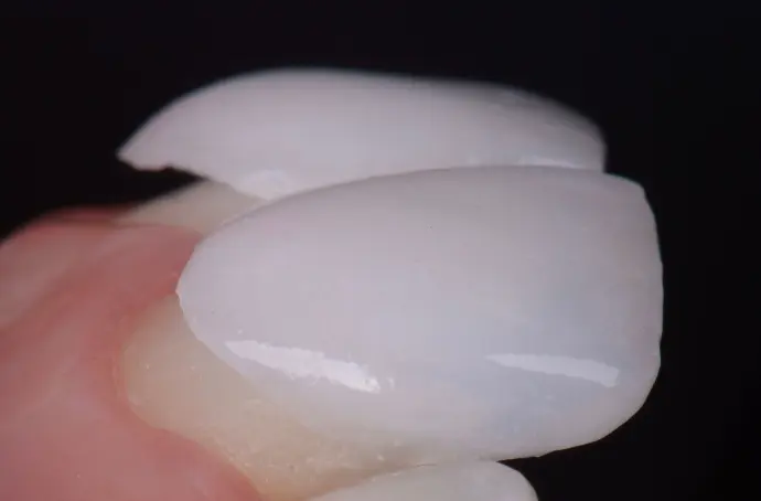 Dental Veneer done in Aliso Viejo AVF