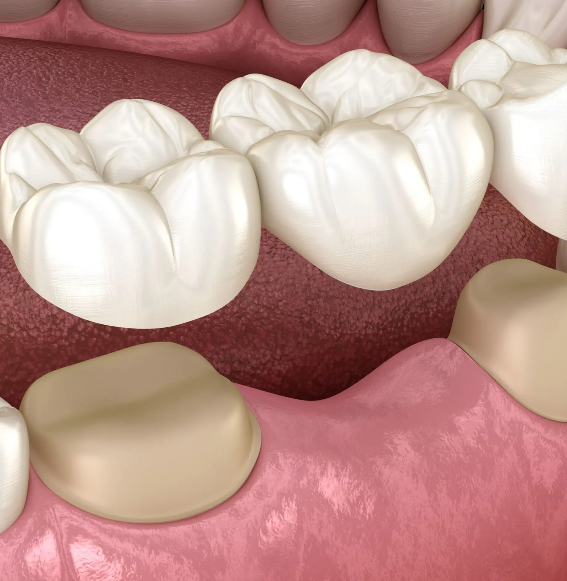 Dental Bridge in Aliso Vijeo