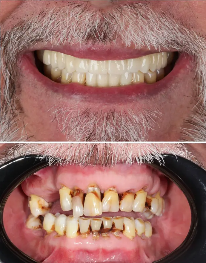 before and after full mouth reconstruction