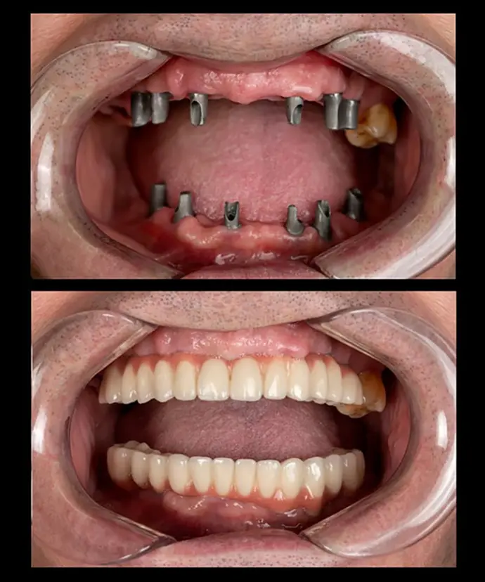 Multiple Implant Before &amp; After picture