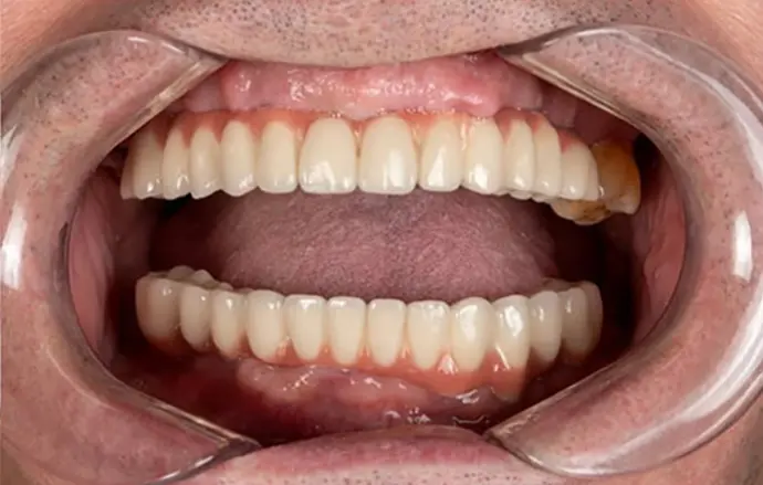 Result of all on 6 implant