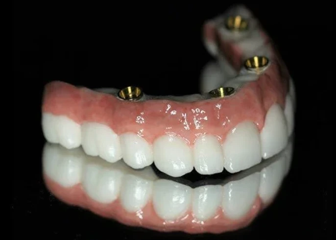 Implant Denture Image