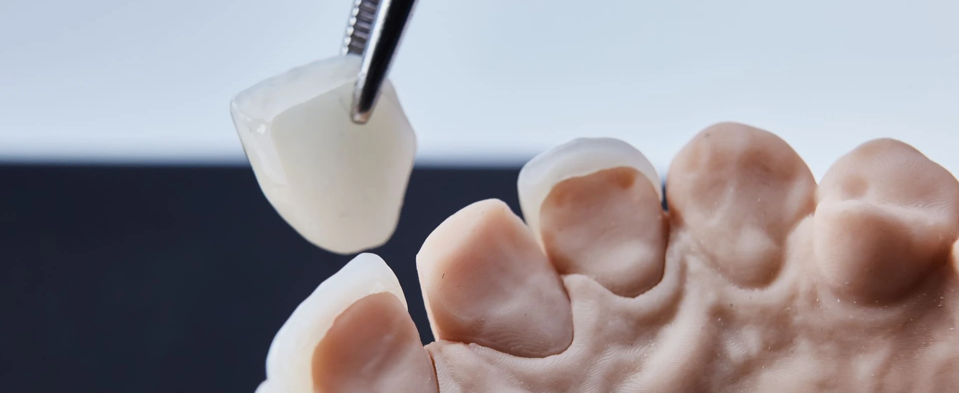Dental Veneer